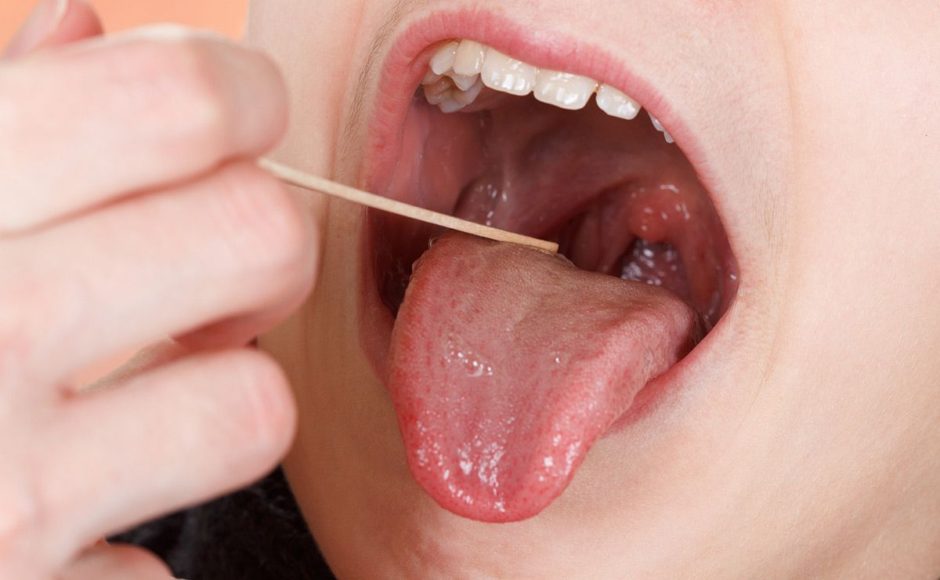 Top 3 Common Causes of Tonsil Stones