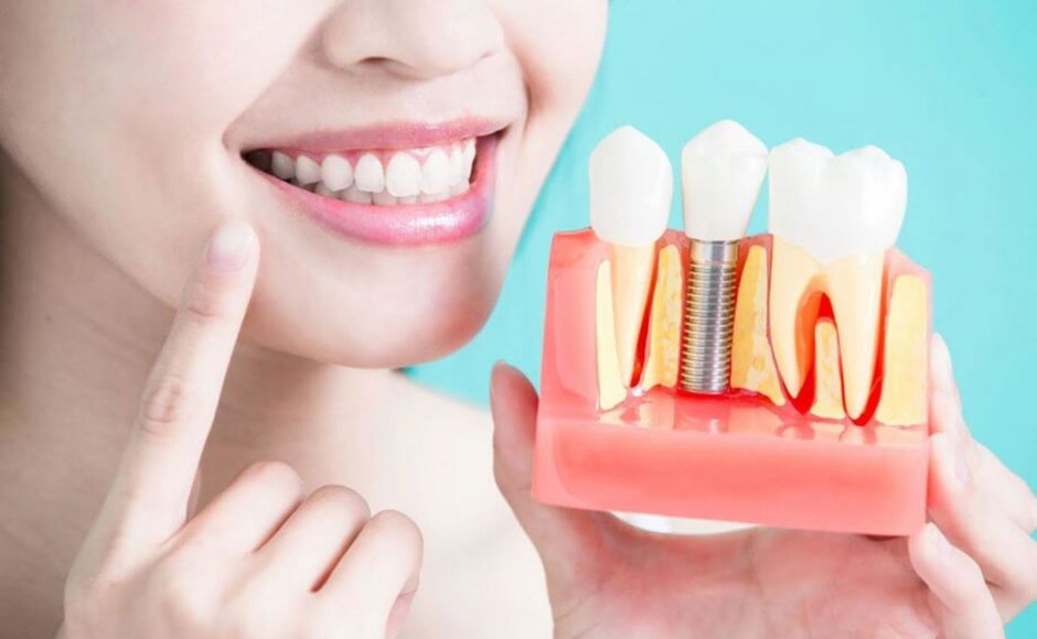 A Permanent And Effective Replacement Of Your Lost Tooth