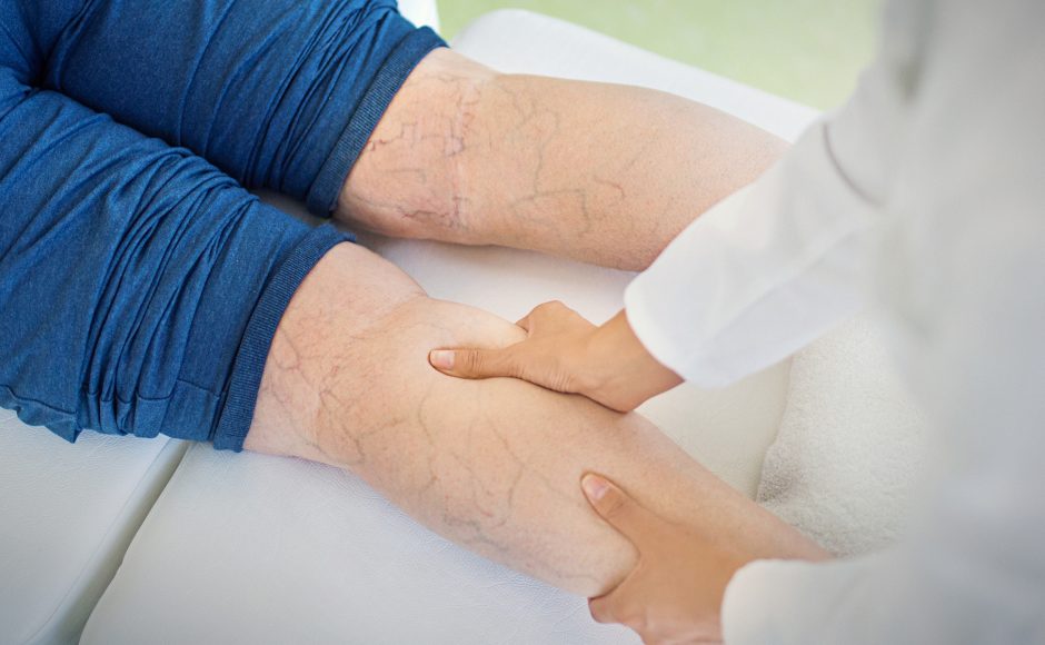5 Daily Habits That Could Leave To The Development Of Varicose Veins